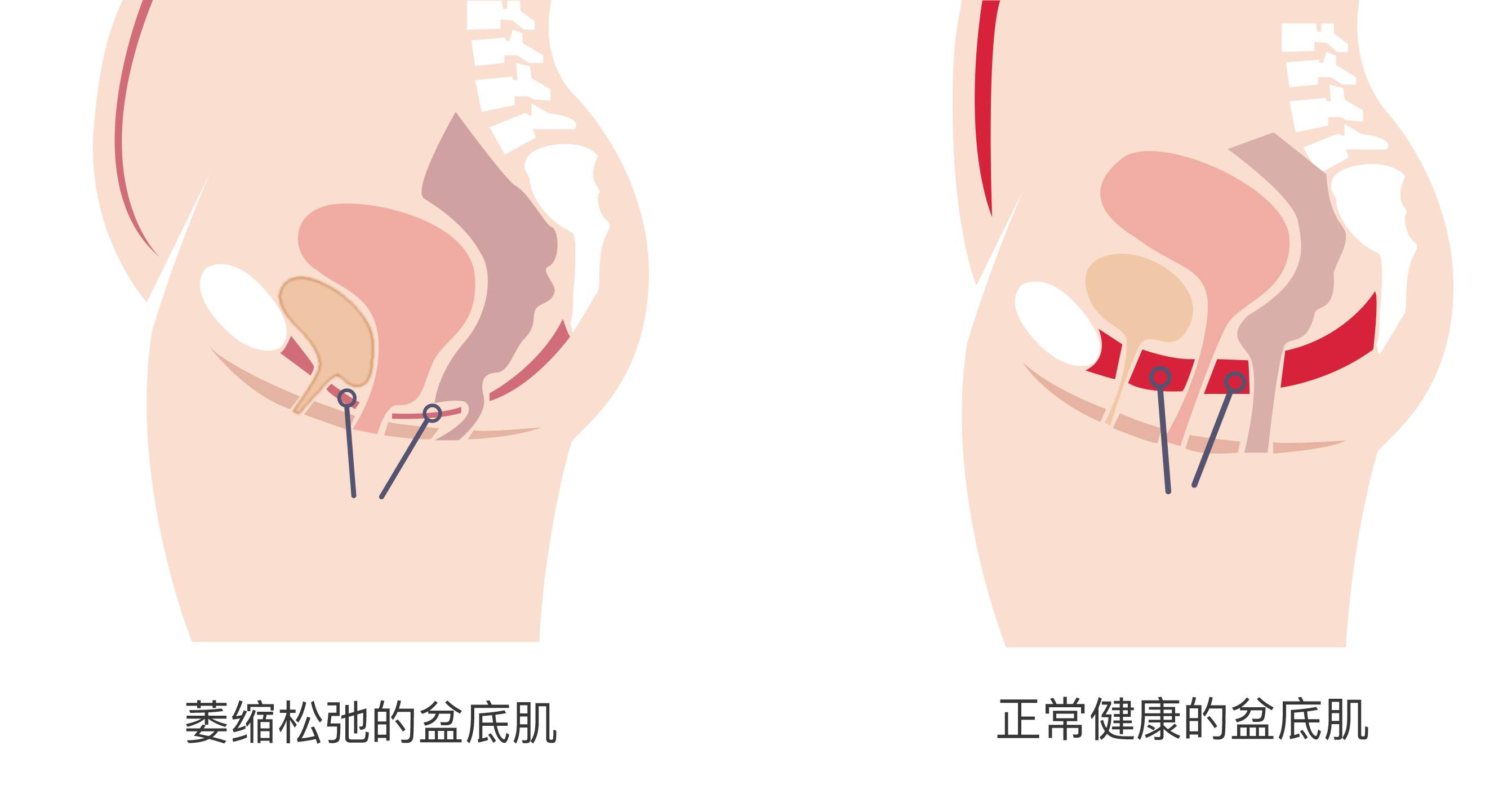 做完盆底肌康复治疗后，为什么会出血？