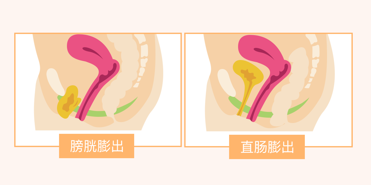 盆底肌受损主要有那几种表现？这4种症状需要谨记，不然后果很严重