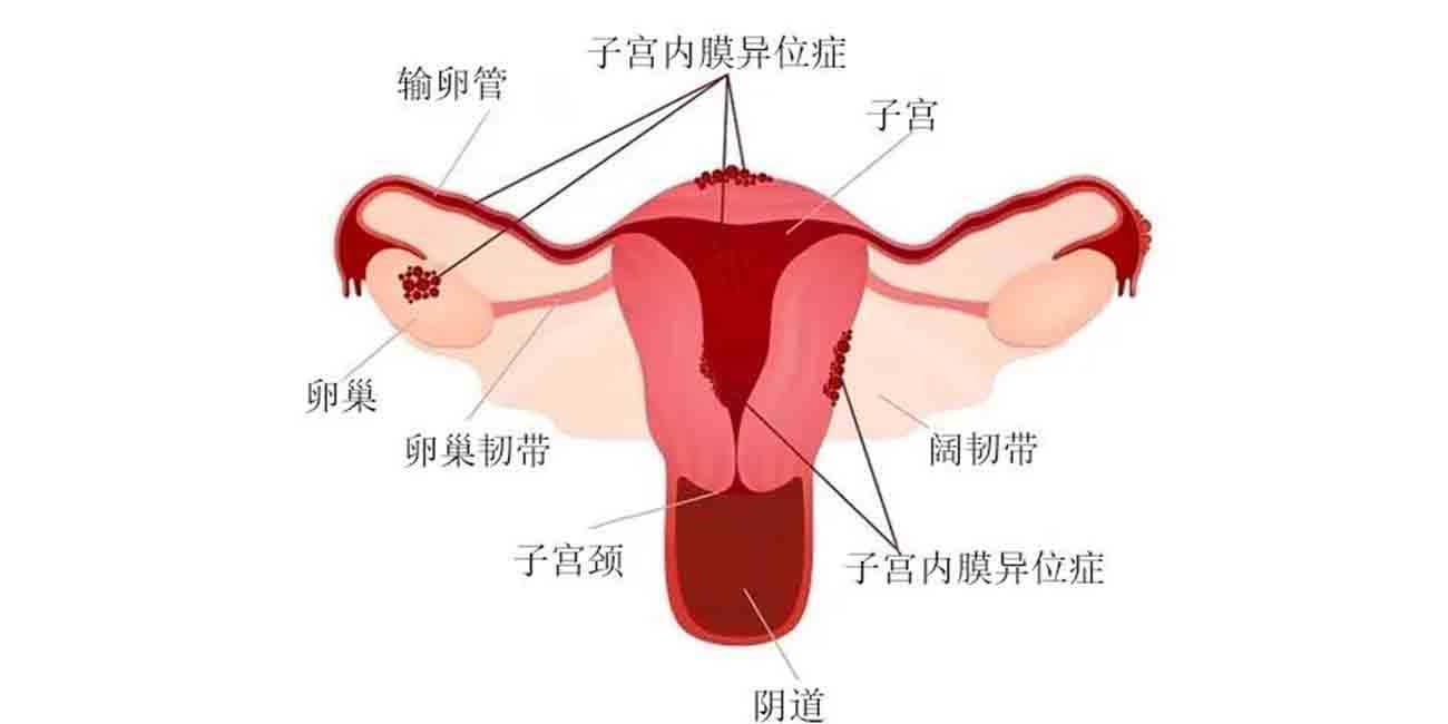 子宫内膜异位