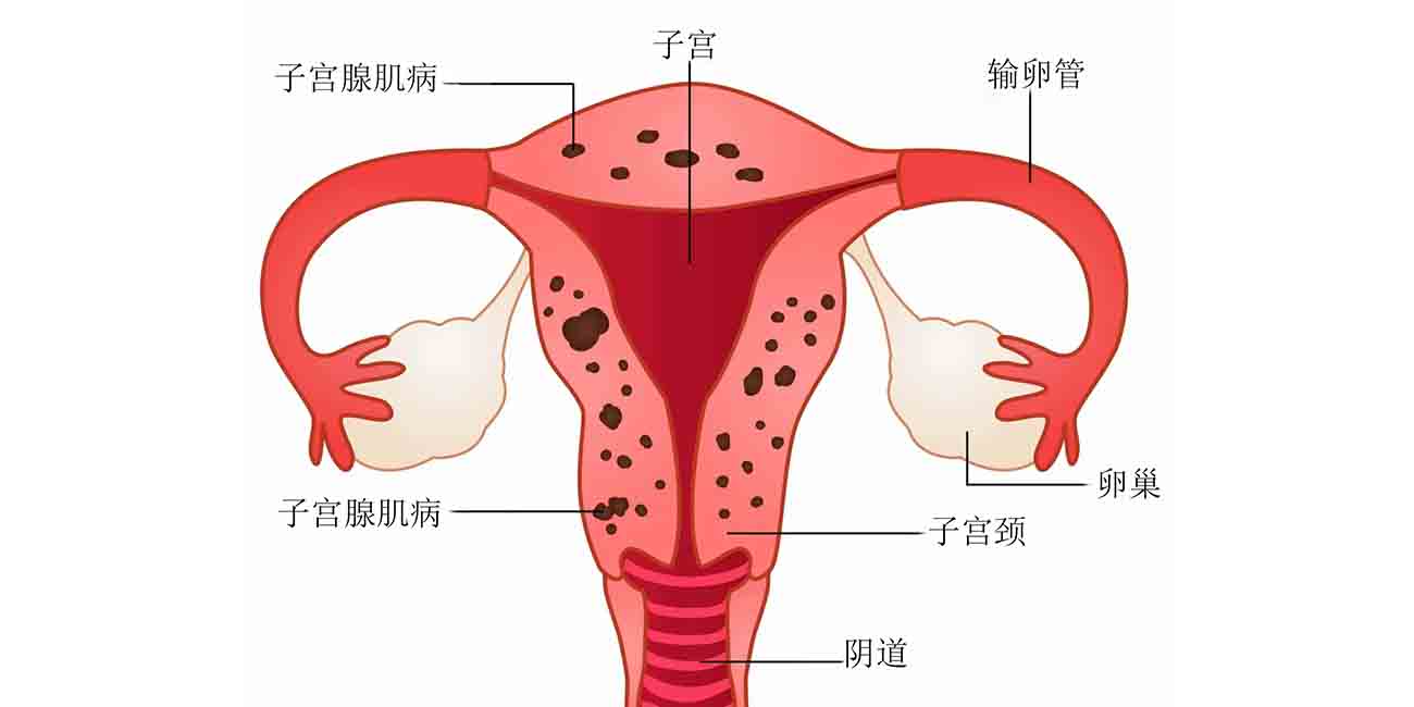 慢性盆腔疼痛的原因有哪些？主要是这5个