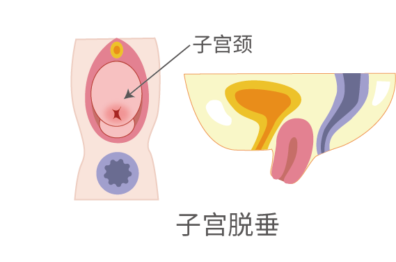 子宫脱垂的康复疗法汇总！中西医可巧妙搭配