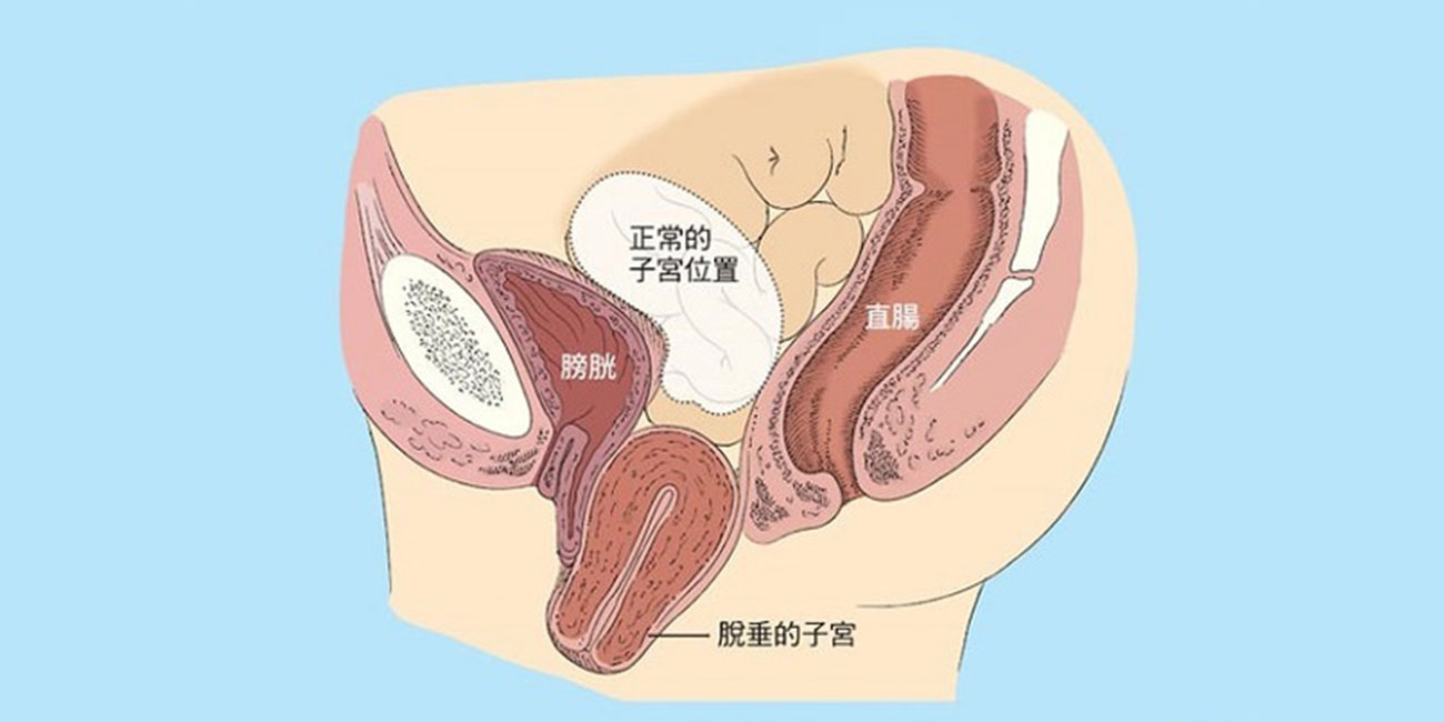 盆腔脱垂 | 从裤子里掉下来的无奈(图3)