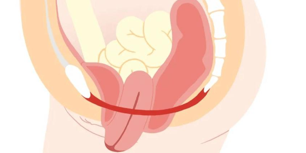 生完娃很多年，还要不要做盆底康复？(图2)