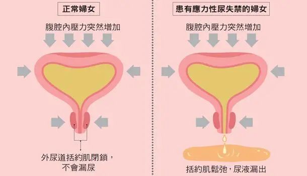 生完娃很多年，还要不要做盆底康复？(图3)